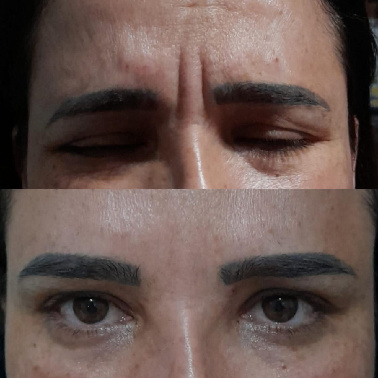 Antes e depois de tratamento na glabela, paciente da Pelíssima Clinic